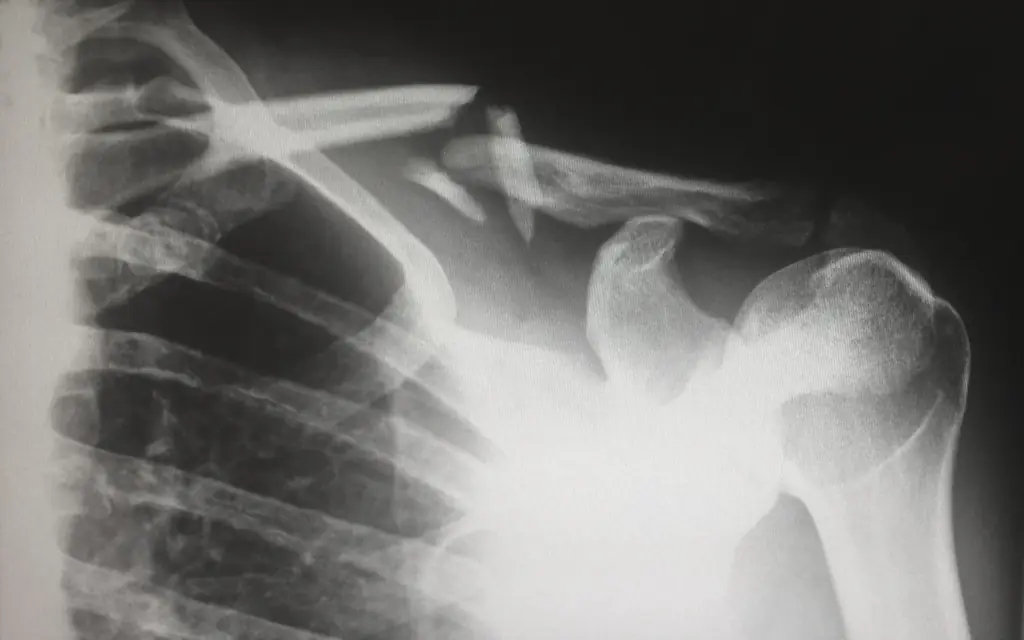 Osteoporoz (Kemik Erimesi)