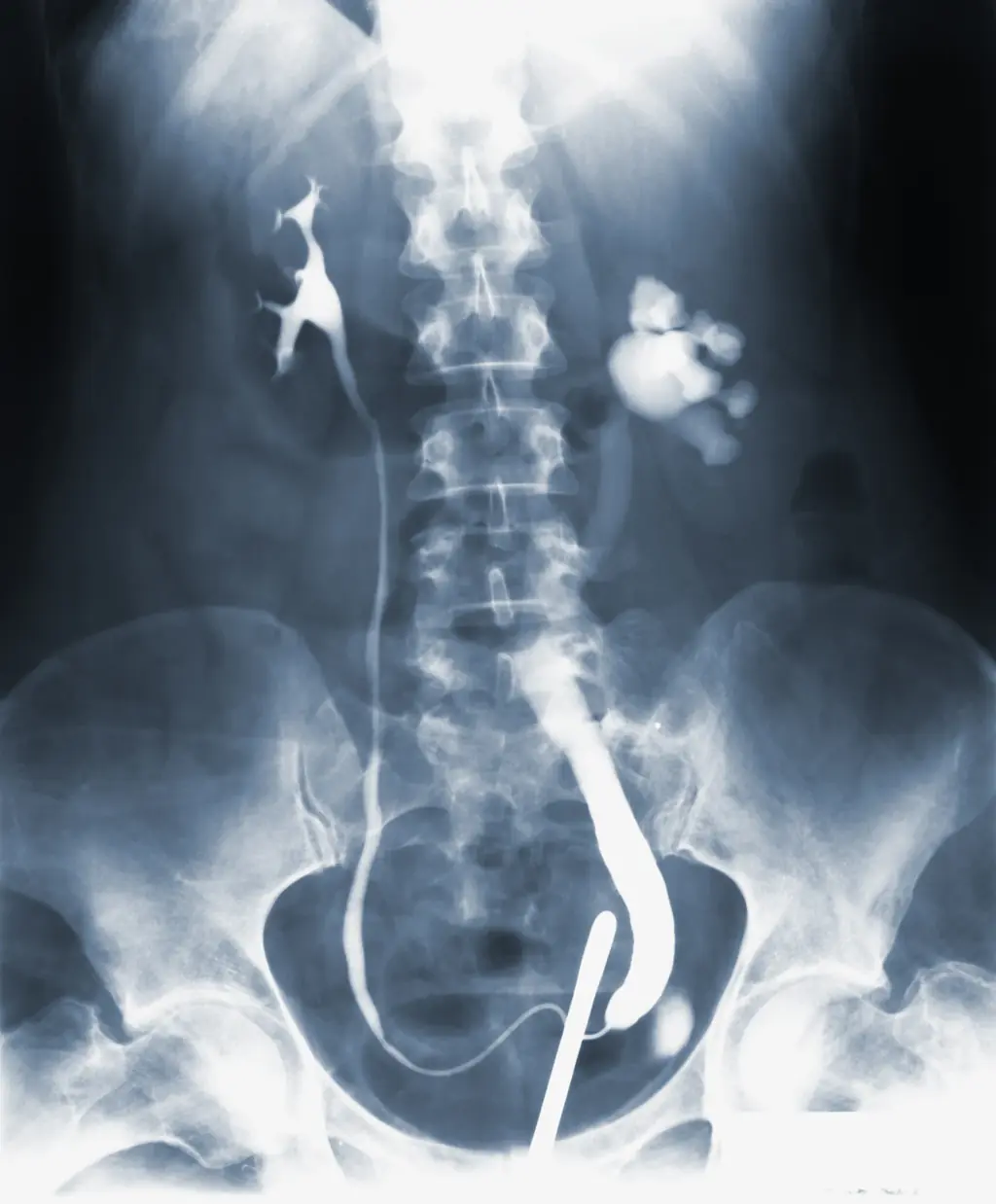 Osteoporoz (Kemik Erimesi)